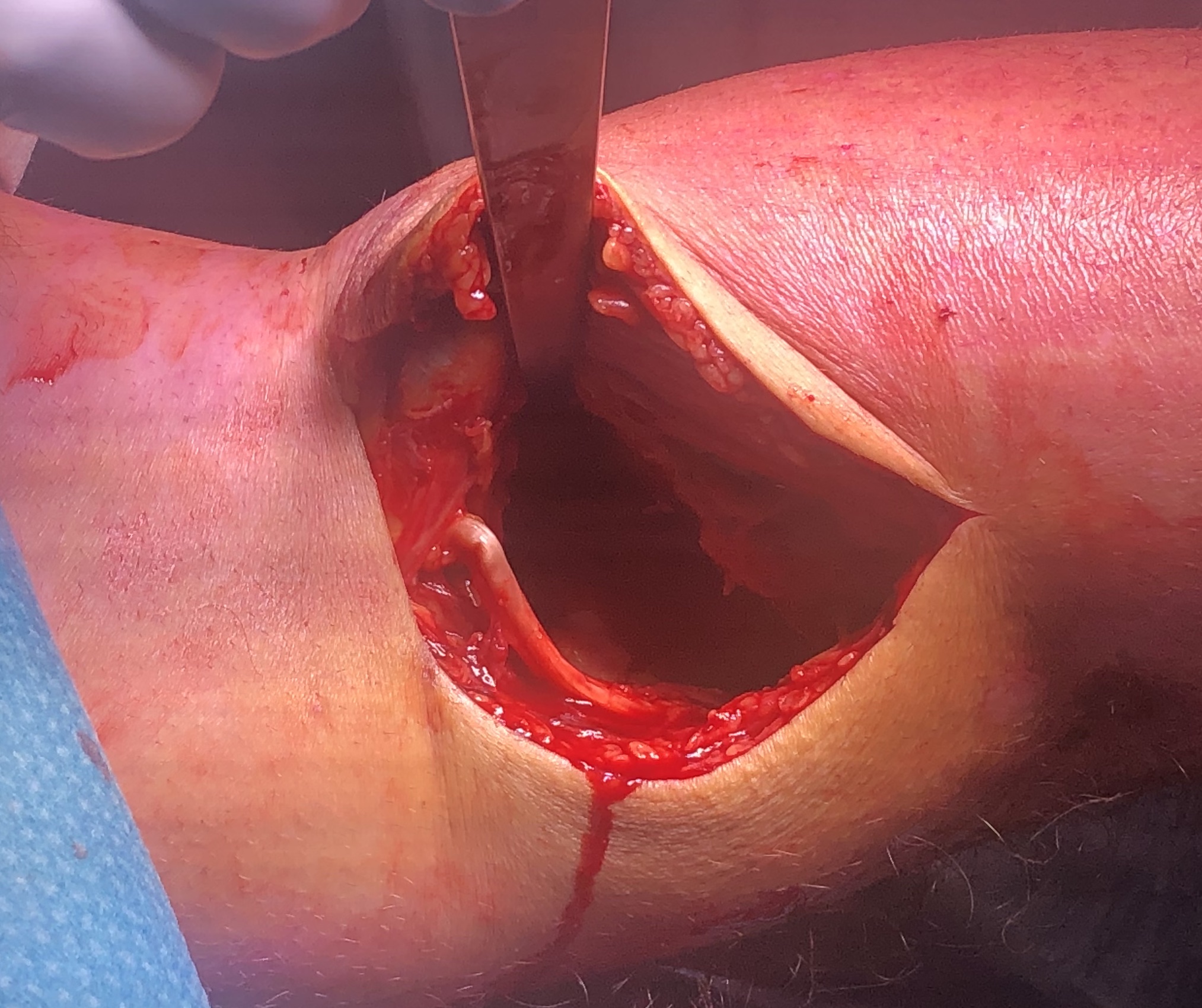 Posteromedial approach knee 2